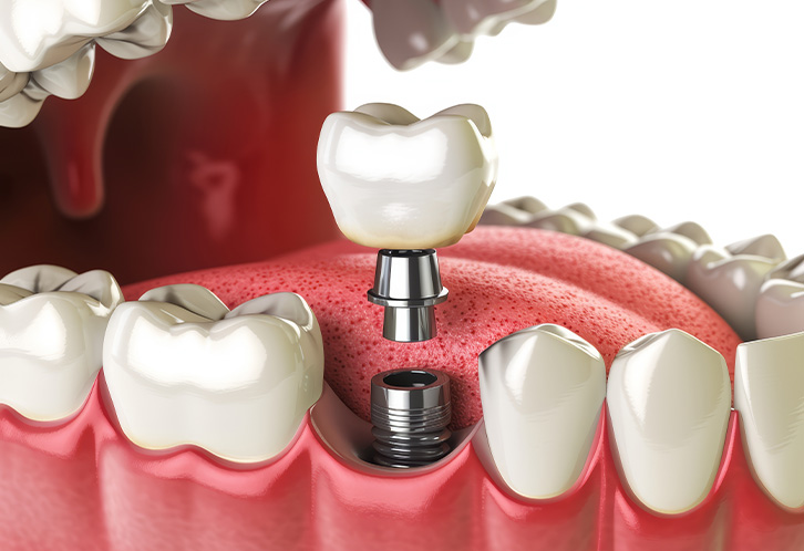 mediDental care | Dental Fillings, Oral Exams and Ceramic Crowns