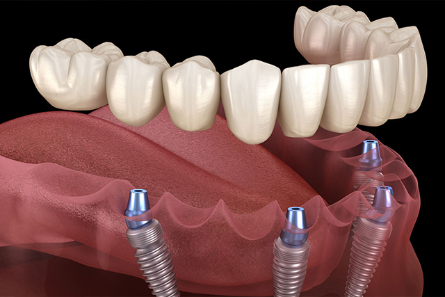 mediDental care | Dental Extractions, Implant Restorations and Root Canals