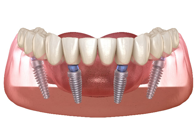 mediDental care | Invisalign reg , Implant Restorations and Root Canals