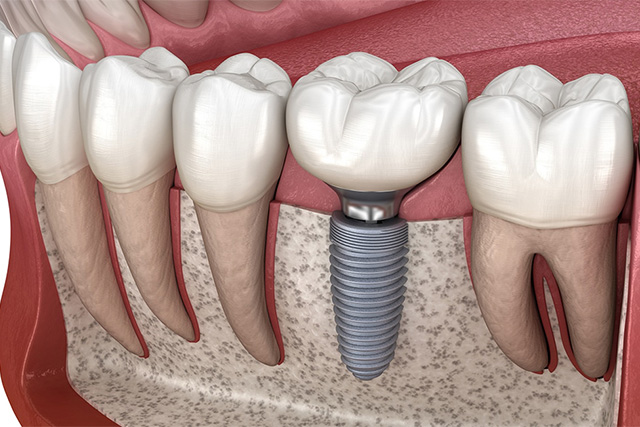 mediDental care | Dental Fillings, Oral Exams and Ceramic Crowns